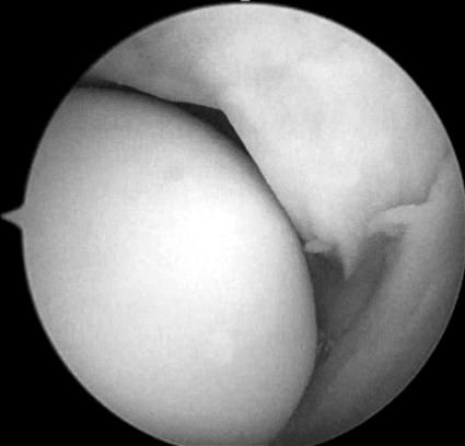 (C) Arthroscopic excision of plica was performed and impingement of plica disappeared even in the extended position of elbow. Radius. Humerus. 적검사나 MRI를이용할수있다.