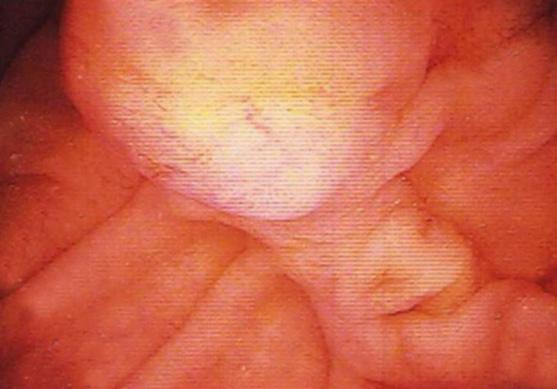 It shows a diffusely dilated bile duct and pancreatic duct. Figure 3.