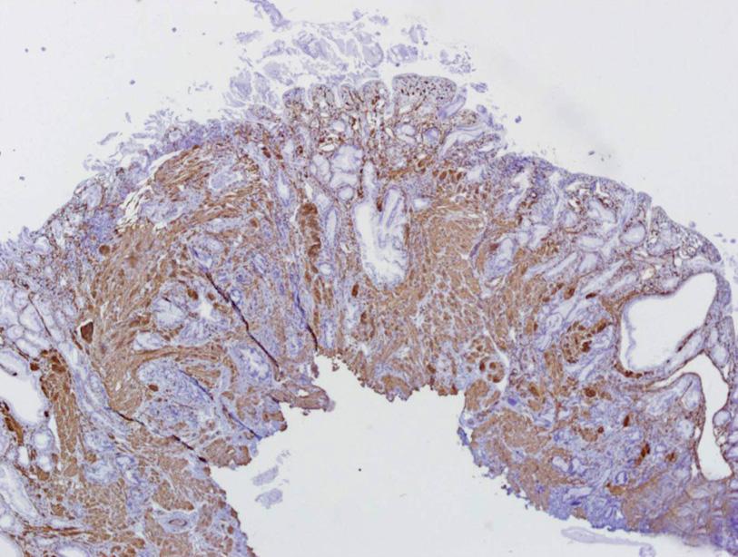 Figure 6. Immunohistochemical findings. (A) Stain for CK (AE1/AE3) highlights epithelial cells (Immunohistochemical stain, 40).