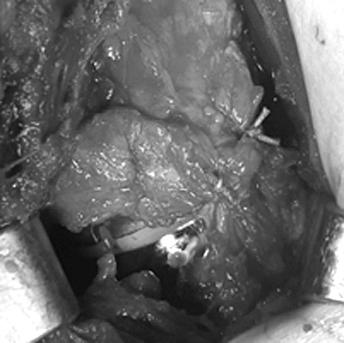 318 Chang Hyuk Choi, et al. A B C D E F Figure 1. (A) An intraoperative photograph shows skin incision for the anterosuperior approach.