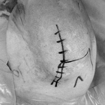 (C) An intraoperative photograph shows the sutures to reattach anterior deltoid.