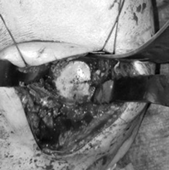 (E) An intraoperative photograph shows the glenoid exposure and retractors placement for the deltopectoral approach.
