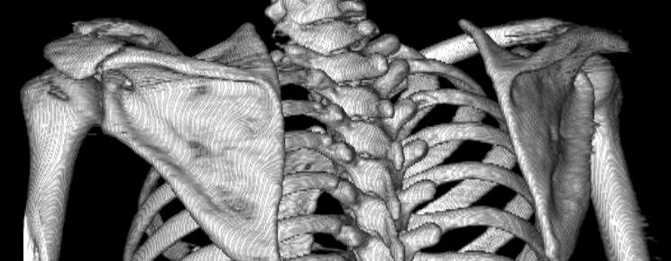 (B) Posterior view of 3D-CT image shows the fracture of base of acromion. 이용해오구돌기의근위부를촉지하여도수정복이후유관나사를이용한내고정술을시행하여분리된 2개의요소를모두수술적으로고정하였다.