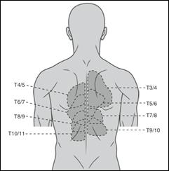 Fig. 3. Pain referral patterns from the thoracic facet joints From Dreyfuss P et al. Spine. 1994;19:809).