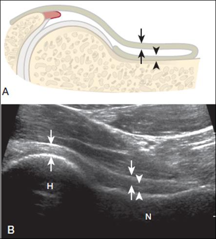 Bedside to Evidence, Evidence to Bedside Fig. 2. Hip joint effusion. Ultrasound image shows anechoic anterior joint recess distension (arrowheads). The KorEan Society of AnesthesioLOgists Fig. 1.