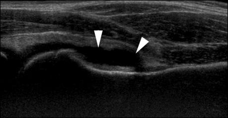 (B), An ultrasound image show the anterior layer of the joint capsule (arrows and the posterior layer (arrowheads).