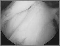 Weakened rotator cuff posterior-superior shoulder pain Similar with labral injury locking,