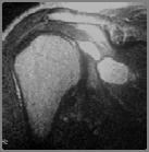 glenohumeral joint evacuation Labral repair ± open decompression of nerve & cyst excision 1.