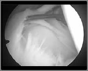 관절와순손상 Glenoid Labrum Injury 4. 관절와상완관절탈구 Dislocation of Glenohumeral Joint 5. 어깨불안정성 Shoulder Instability 6.