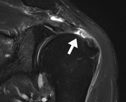 57-year-old man with partial articular supraspinatus tendon avulsion confirmed by arthroscopy. A.