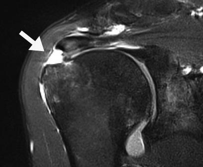 critical zone of the supraspinatus. B. The MR image corrected to a 896 window width and a 364 window level shows a partial-thickness tear (arrow). A B Fig. 3. 51-year-old man with right shoulder subacromial impingement syndrome.