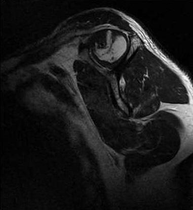 lipoma (B), coronal section on T2 fat suppression image shows the lipoma (C).