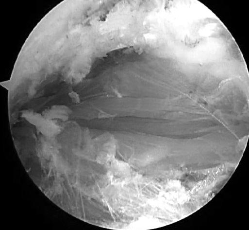 (B) Arthroscopic photography shows that the lipomas was removed from the supraspinatus muscle.