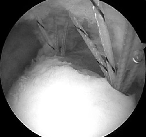 (D) Arthroscopic photography shows that a foot print of the supraspinatus.