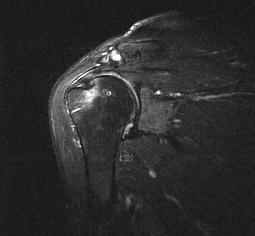 52 Dong-Ju Shin, et al Figure 5. (A) Follow-up magnetic resonance imaging (MRI) (postoperative one-year later) coronal section shows that remaining lipoma tissue (arrow).