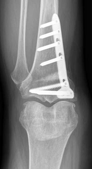 381 TomoFix versus Aescula Plates A B C Figure 2. Long locking plate (A) and short spacer plate (B) were used for high tibial osteotomy.