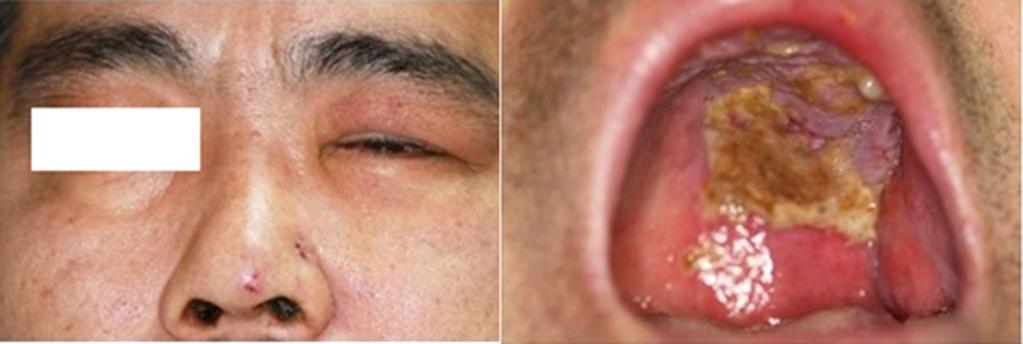 - 현상윤외 : 안면부대상포진후발생한장액맥락망막병증 - A B Figure 1. Face photos showing facial herpes zoster.