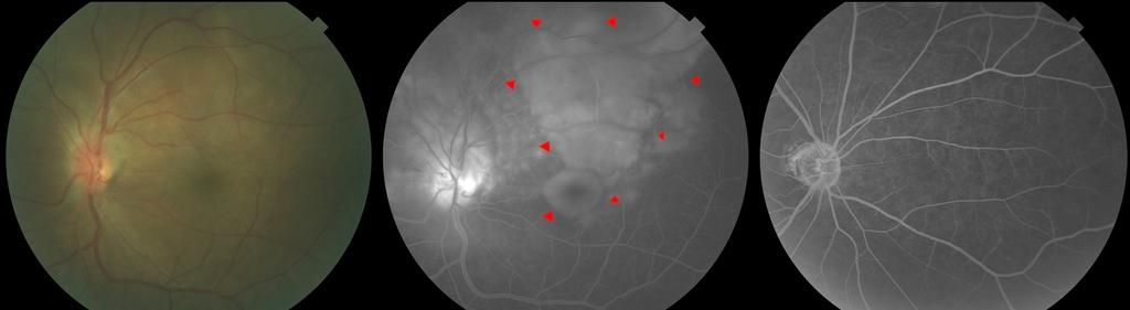 detachment (arrowheads) between optic disc and  (C) After treatment (two months later), fluorescein