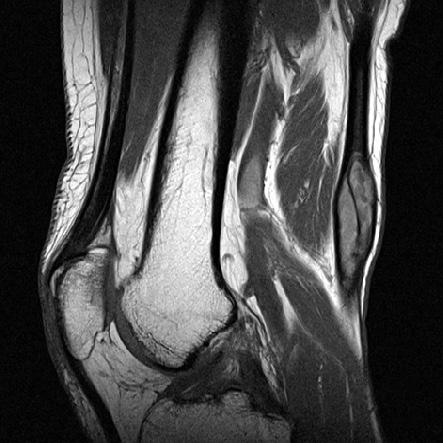 90 조진호 Figure 2. Magnetic resonance images shows well-defined soft tissue mass along semitendinosus tendon, posterior aspect of distal thigh.