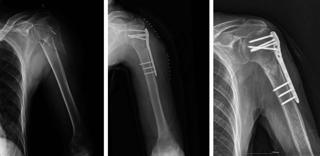 김동욱 : 각안정잠김압박금속판을이용한전위된근위상완골골절에대한수술적치료 A B C Fig. 1. 78 year old man with three part fracture and C1 fracture. (A) Preoperative radiograph.
