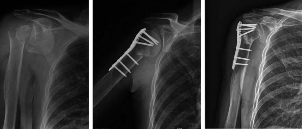 68 year old woman with fracture and dislocation of the proximal humerus and B3 fracture. (A) Preoperative radiograph.