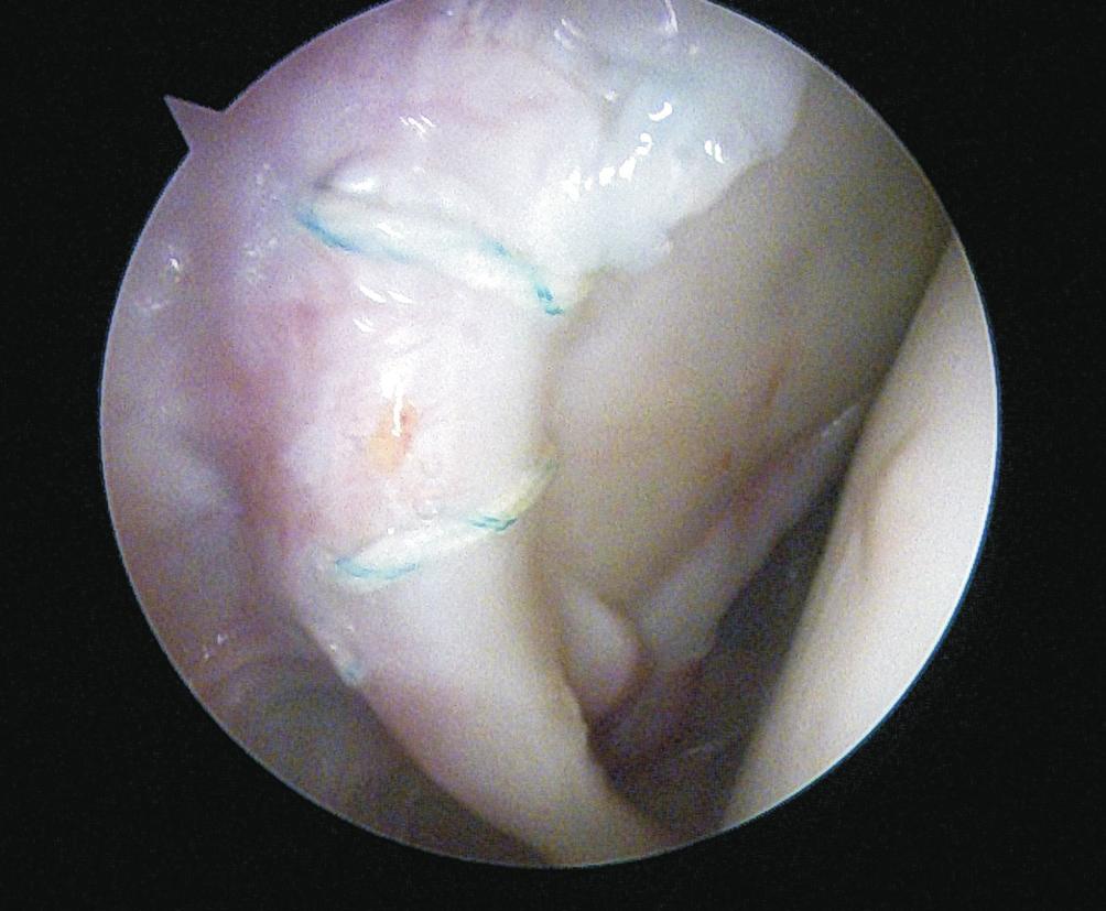 superior glenoid. Figure 3. Removal of loose stitch. 가많다. 보존적치료는 6개월이상복합적으로시행한뒤환자의증상이경감하지않으면수술적치료를고려할수있다.