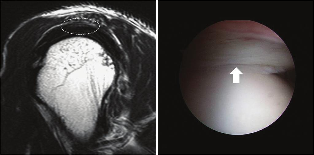 %에 달한다 (9). 어 a b c d Fig. 4. The false-negative partial-thickness tear of the supraspinatus tendon in 39-year-old man.