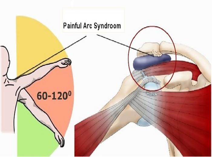 5 통증호증후군검사 (Pain Arc Test) 1) 검사목적가시위근힘줄염손상부위감별진단충돌증후군