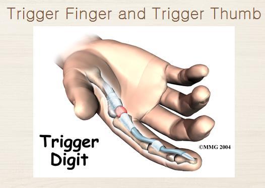 Trigger Finger 협착성건초염의일종.