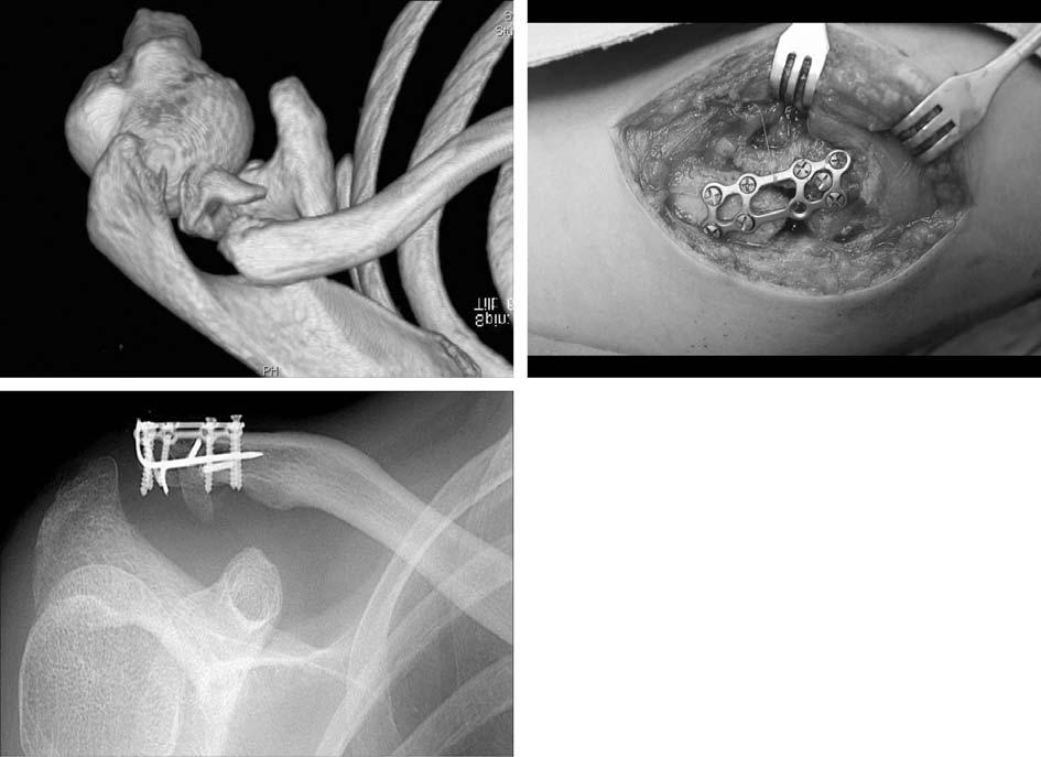 강호정 : 원위쇄골불유합의수술적치료 A B C Fig. 3. (A) CT for a 29-year-old woman. Neer type III fracture nonunion infiltrating A-C joints.