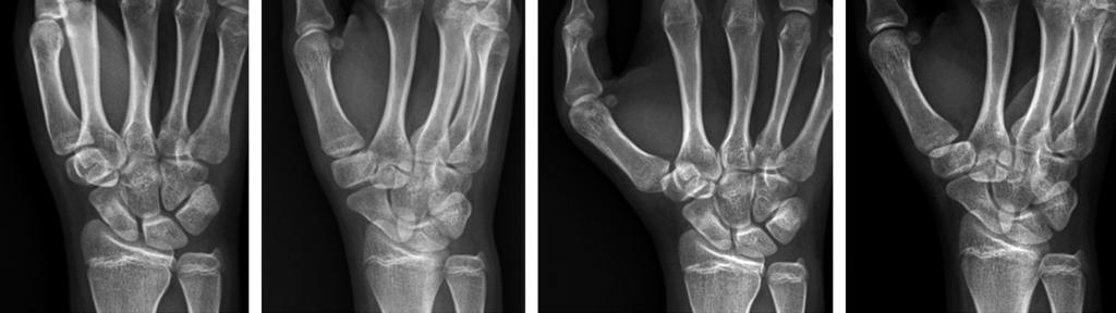 J Korean Soc Surg Hand Vol. 21, No. 4, December 2016 A B C D Fig. 2. (A, B) Plain radiographs at 3 days after injury showed normal positioning of the carpometacarpal joint of the thumb with uniform joint space.