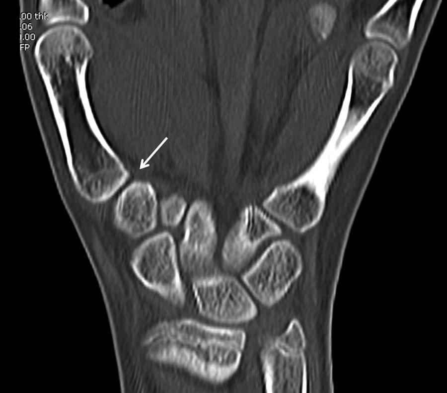 (D) Oblique radiograph of semipronated wrist at 4 months after injury showed widened interval between first and second metacarpal bone base and non-parallel joint space in comparison with initial