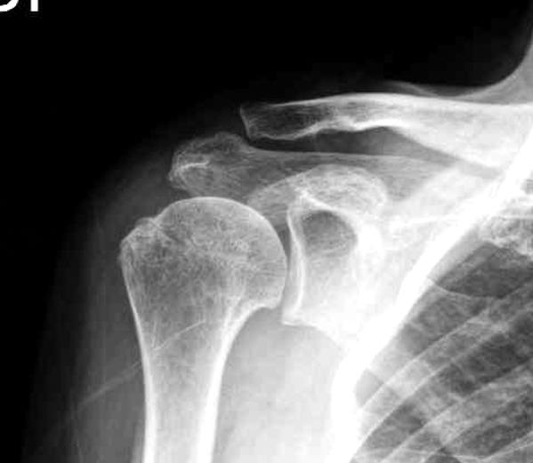 대한류마티스학회지제 14 권제 4 호 2007 Fig. 1. Glenohumeral AP view of right shoulder shows sclerosis and irregularity of greater tuberosity. 본 1. 회전근개파열은자기공명영상이나초음파등이있어야진단할수있다.