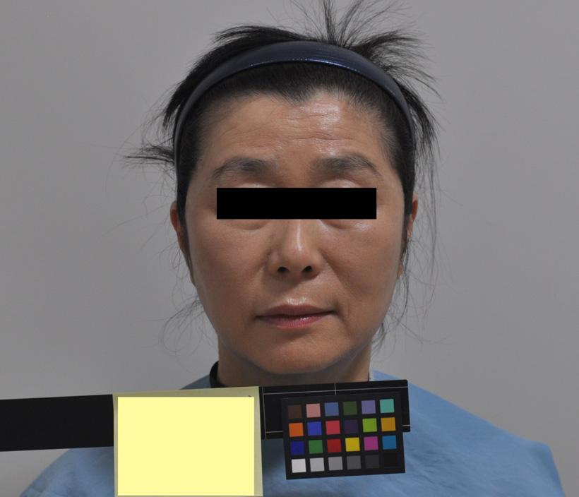 106 Parkinson`s Disease Patient Treated with Yuldahanso-tang gagam Table 1. Circumference of Body Measure region Circumference(cm) Measure region Circumference(cm) Forehead Circumference 56.