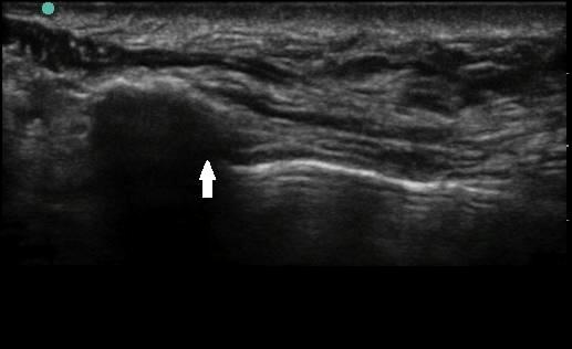 100 Anesth Pain Med Vol. 9, No. 2, 2014 Fig. 2. Imaging of the infraorbital foramen, long axis view. (A) Anterior view of the human skull.