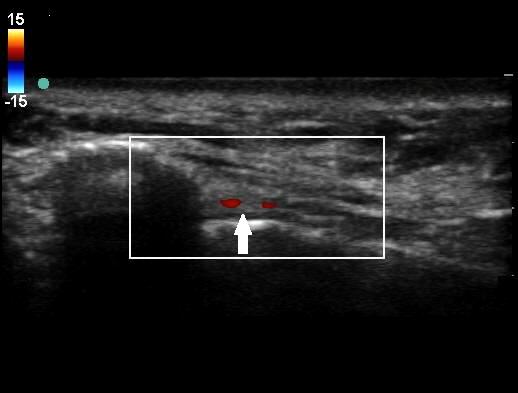 (C) Color doppler demonstrates the infraorbital artery (arrow) in long axis view. 경과후안와하부부종은호전되었다. 시술후 5개월째추적관찰중이며 NRS 1-2/10점으로유지되고있다. 고찰삼차신경통은안면부의제 5뇌신경의분포영역에발생하는반복적인극심한발작성통증을특징으로하는드문질환이다 [2].