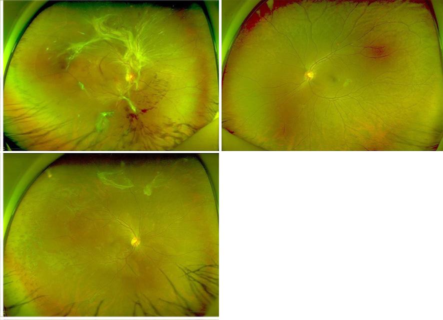 - 이가인외 : 견인망막박리에서진단된타카야수동맥염 - A B C Figure 1. Widefield fundus photographs of right eye.