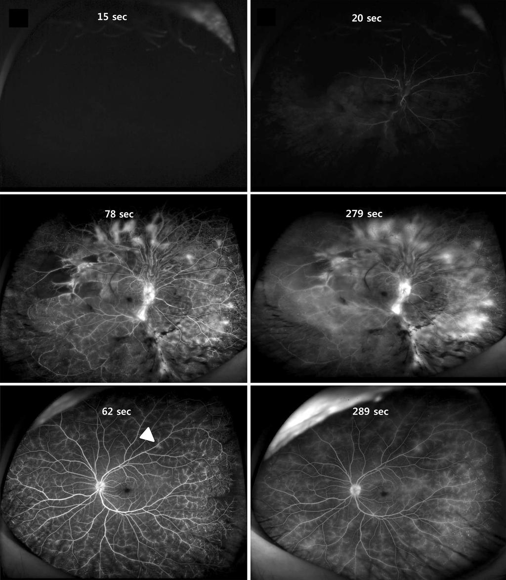 - 대한안과학회지 2017년 제 58 권 제 5 호 - A B C D E F Figure 2. Fluorescein angiography of right eye at initial visit. (A, B) Early-phase fluorescein angiography shows delayed filling of artery.