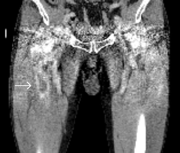 muscles, abutting the adjacent femur (arrow). (B) A CT coronal scan shows the same rim enhancing cavitary lesion (arrow). A B Figure 2.