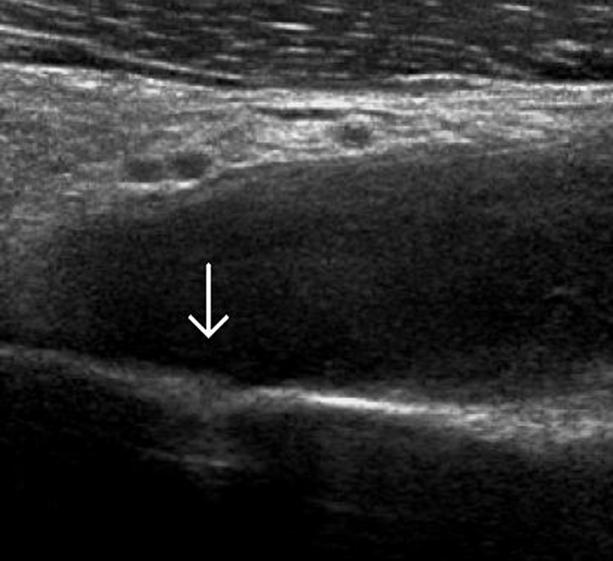 (arrow). (B) A color Doppler US shows a peripheral hyperemia.