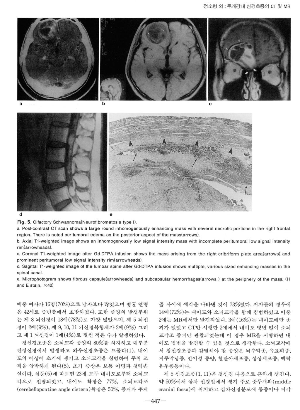 정소렁오 : 두개강내신경초종의 CT 및 MR a b c d e Fig. 5. Olfactory Schwannoma(Neurofibromatosis type Il a.