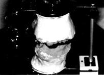 시술결과 1991년 2월이후로부터현재가지최종보철물을장착한 6명의환자에서모두 15개의 Cylinder or Screw type의 implant fixtures를상악동거상술과동시에또는지연매식한후 1995년