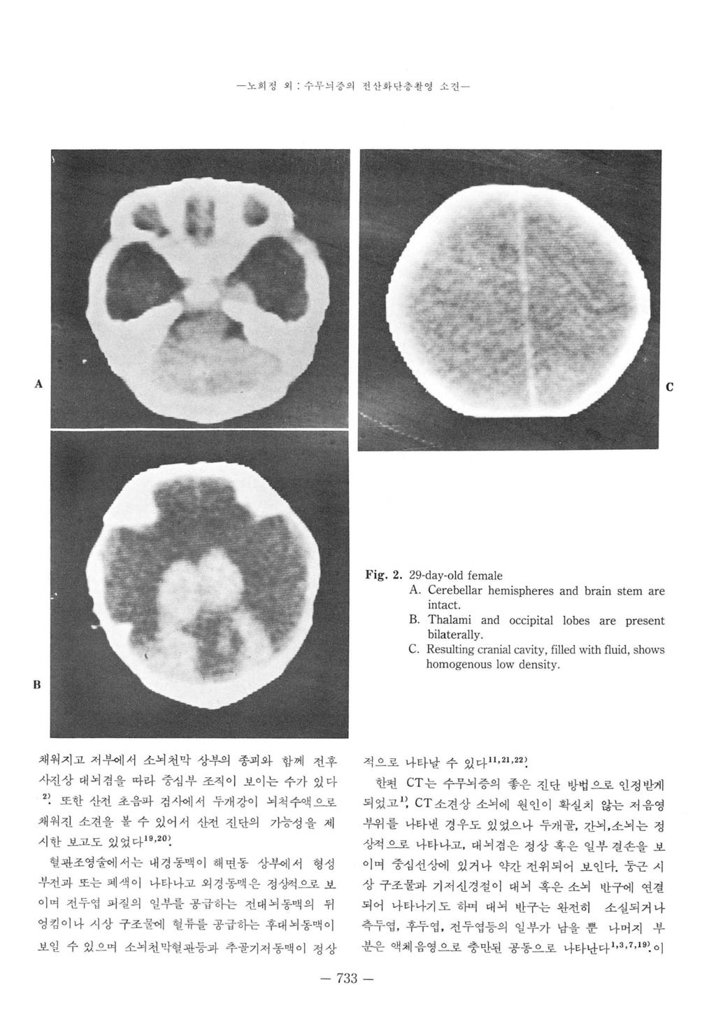 노호 l 정외수우늬증의전산화만층활영소견 - A c B ig. 2. 29.day-old female A. Cerebellar hemispheres and brain stem are mtact B Thalami and occipital lobes are present bilaterally C.
