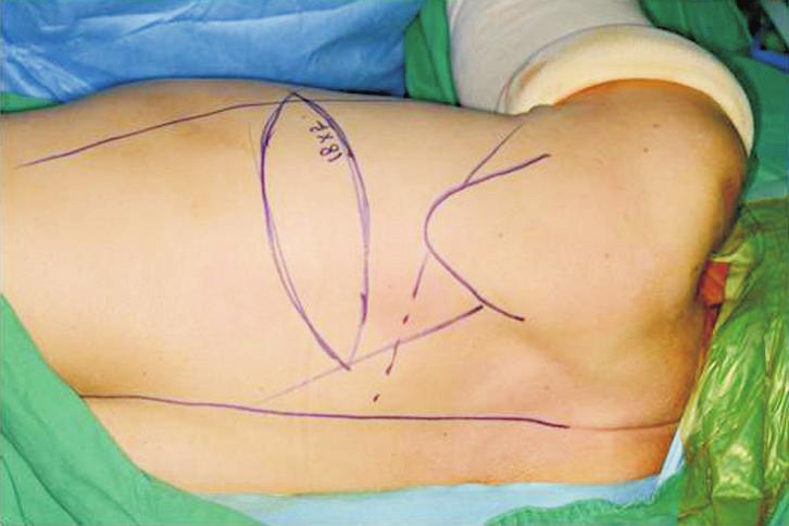 (C) 1: in tercostal artery perforator flap; which was original skin pa d dle of LD flap.