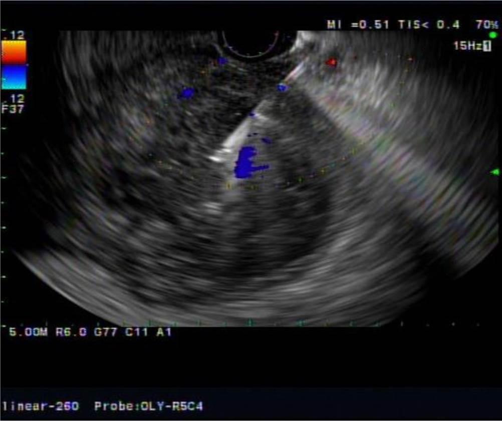 남광우 외 1인. 내시경초음파 유도하 중재시술 내시경초음파 유도하 담낭배액술(EUS-guided gallbladder 난이도가 높은 편이다.