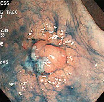 - Sun Hyung Kang, et al. Treatment of gastric adenoma - 지가있는것이다. Nam 등 [14] 의연구에서연구를주로시행했던기관내에서도 2명의병리의사가있었는데, 전문분야가위암인병리의사가좀더많은조기위암을진단하였다. 경험및진단기준의차이가이런현상을만든것으로보인다.