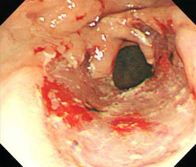 (C, D) After 10 years, early and advanced gastric cancer recurred at other site of remnant stomach. 여자환자로 2006년유문륜의선종으로내시경절제술을시행하였다.