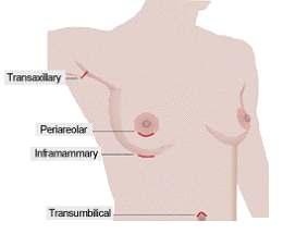 Periareolar - an incision is placed along the