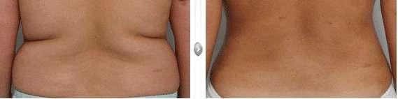 liposuction may be performed under a local anesthesia which numbs the affected areas, usually combined with intravenous sedation. For more extensive procedures a general anesthesia may be used.