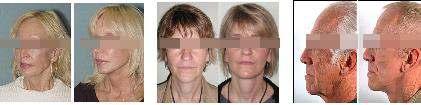 Face lift or Rhytidectomy, is intended to restore a more younger-looking appearance by smoothing out and tightening major wrinkles and sagging skin of the face, neck and jaw line.